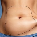 Can you get liposuction without anyone knowing?