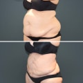 What type of liposuction has the highest complication rate?