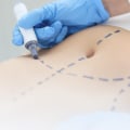 The Truth About Swelling After Liposuction