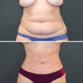 Does liposuction have long-term effects?