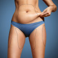 The Truth About Liposuction: Is it Really Permanent?