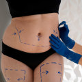 Liposuction: A Plastic Surgeon's Perspective on Weight Loss