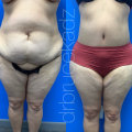 The Truth About Weight Loss and Liposuction