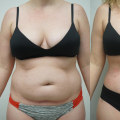 The Truth About Liposuction Results