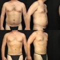 The Most Advanced Liposuction Techniques: A Plastic Surgeon's Perspective