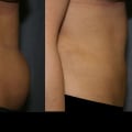 The Truth About Liposuction: What You Need to Know