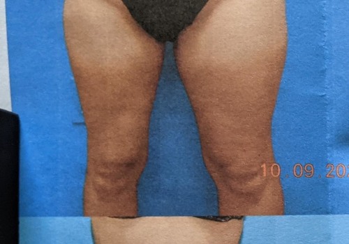 How many inches off your waist after liposuction?