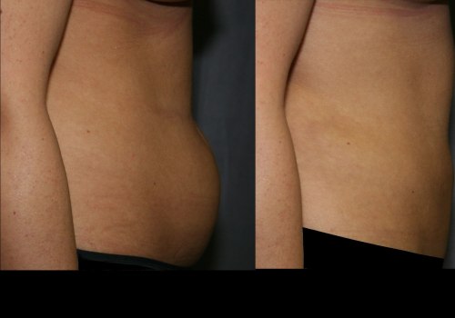 Can liposuction be bad for you?