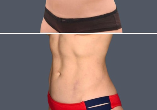 Who is not a good candidate for laser liposuction?