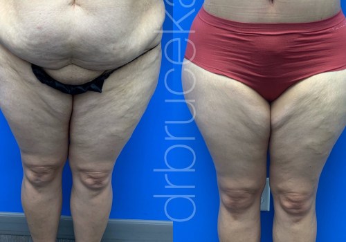 The Importance of Weight in Liposuction Procedures