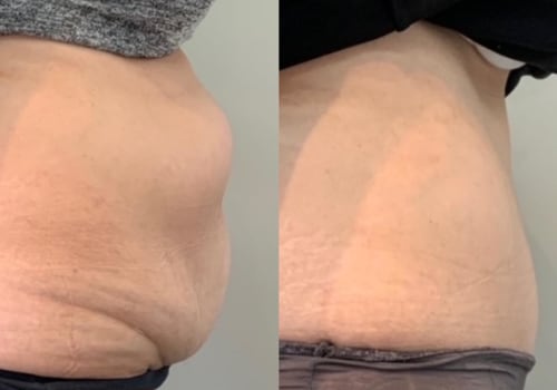 Is it harder to gain fat after liposuction?