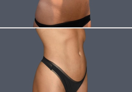 The Truth About Getting a Second Round of Liposuction