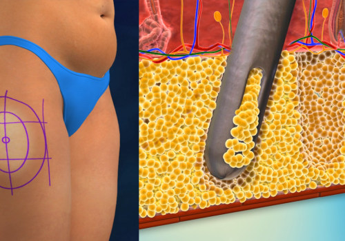 The Most Common Complications of Liposuction: An Expert's Perspective