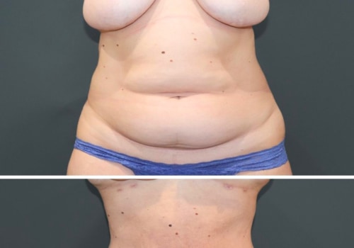 What weight do you have to be to get liposuction?