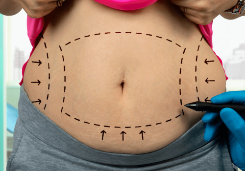 Is liposuction effect permanent?