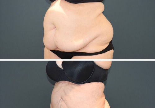 What type of liposuction has the highest complication rate?