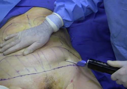 The Maximum Amount of Fat That Can Be Removed with Liposuction in the UK