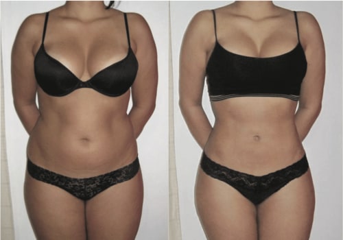 The Final Results of Liposuction: What to Expect and How Long to Wait