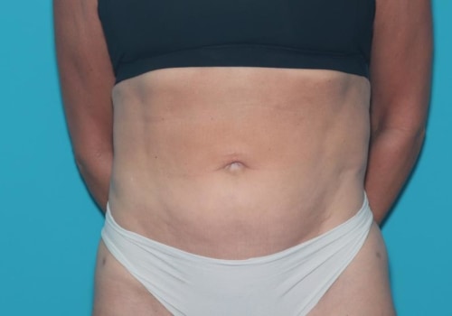 Is liposuction worth doing?