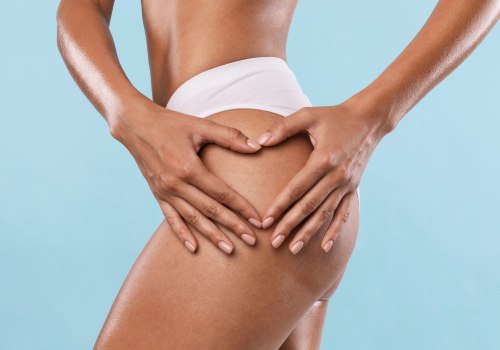 Who is not a good candidate for liposuction?