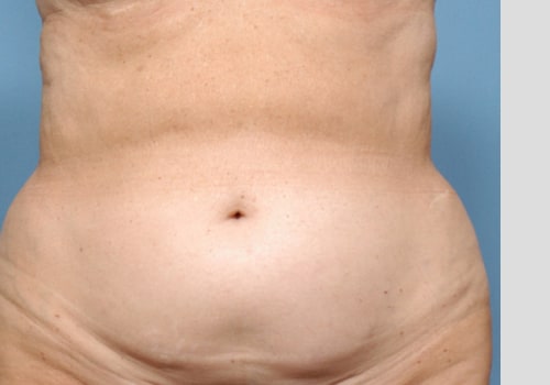 The Truth About Aggressive Liposuction: An Expert's Perspective