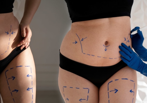 The Truth About Liposuction: How Much Fat Can Really Be Removed?