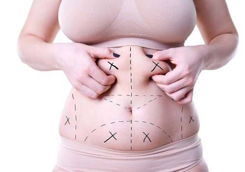 The Truth About Losing Weight After Liposuction