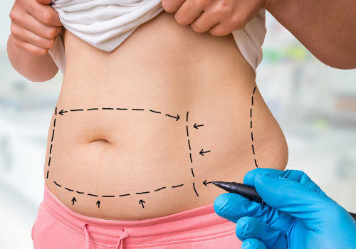 Is liposuction permanent fat loss?