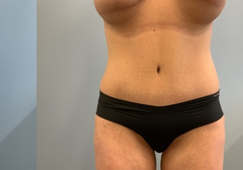 The Truth About Liposuction: Separating Fact from Fiction