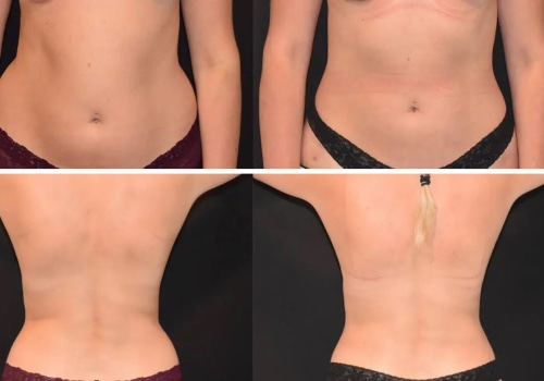 The Truth About Liposuction: Separating Fact from Fiction