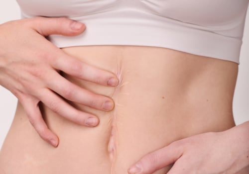 The Truth About Liposuction for 300 Pound Individuals: An Expert's Perspective