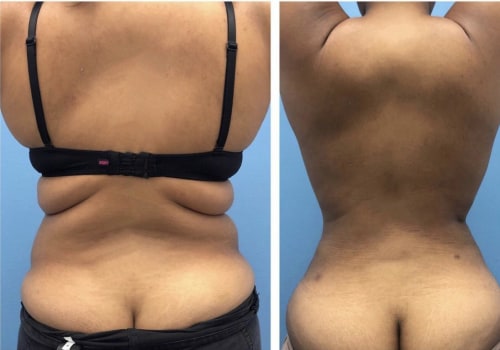 The Truth About Fat After Liposuction