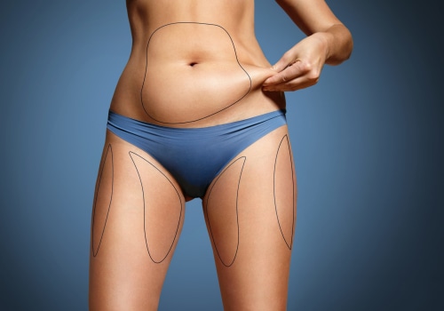 The Truth About Liposuction: Is it Really Permanent?