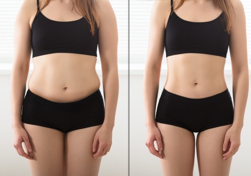 Who is a candidate for laser liposuction?