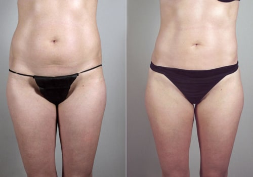 The Truth About Liposuction: Debunking the Myths