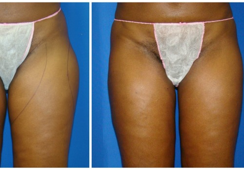 Who is a Good Candidate for Liposuction?