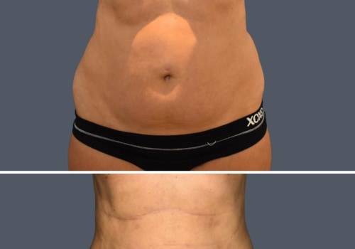 Who is not suitable for liposuction?