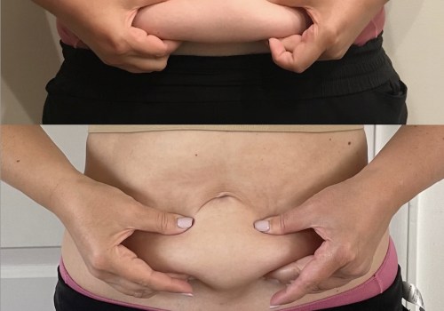 Liposuction: A Contouring Procedure for a Slimmer Body