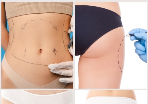 Is liposuction considered a high risk surgery?