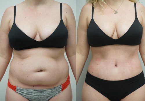 The Truth About Liposuction Results