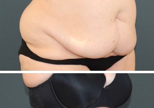 Is Liposuction Safe for Obese Patients?