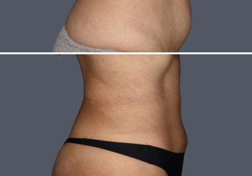 The Truth About Weight Gain After Liposuction