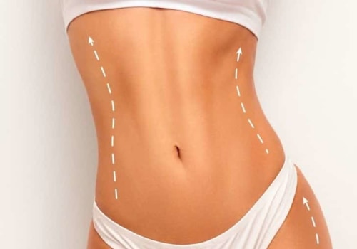 Are You a Good Candidate for Liposuction?