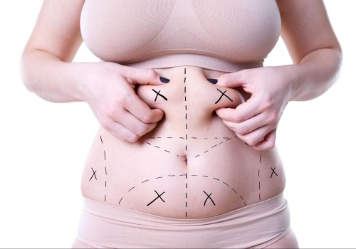 Who should not get liposuction?