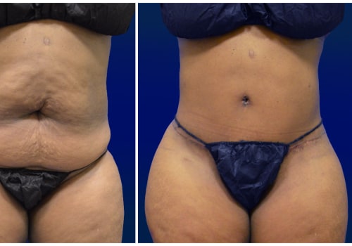 The Truth About Liposuction: An Expert's Perspective