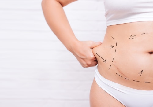 Is Liposuction Suitable for Thin People?