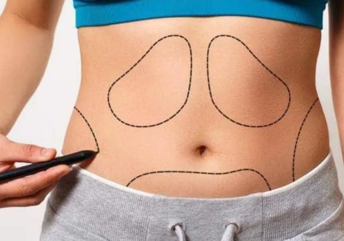 The Truth About Liposuction: Permanently Removing Belly Fat