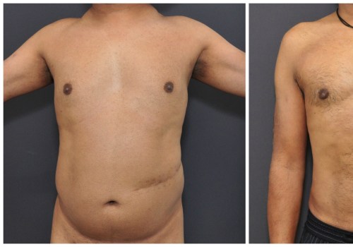 What to Expect After Liposuction: A Surgeon's Perspective