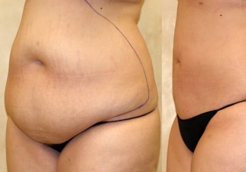 The Truth About Weight Limits in Liposuction