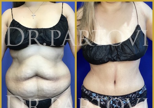 The Truth About Liposuction: How Much Can You Really Lose?